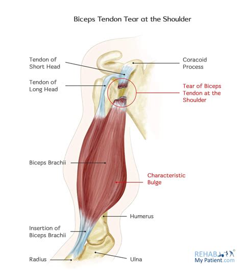 bicep tear test at home|biceps tendon tear at shoulder.